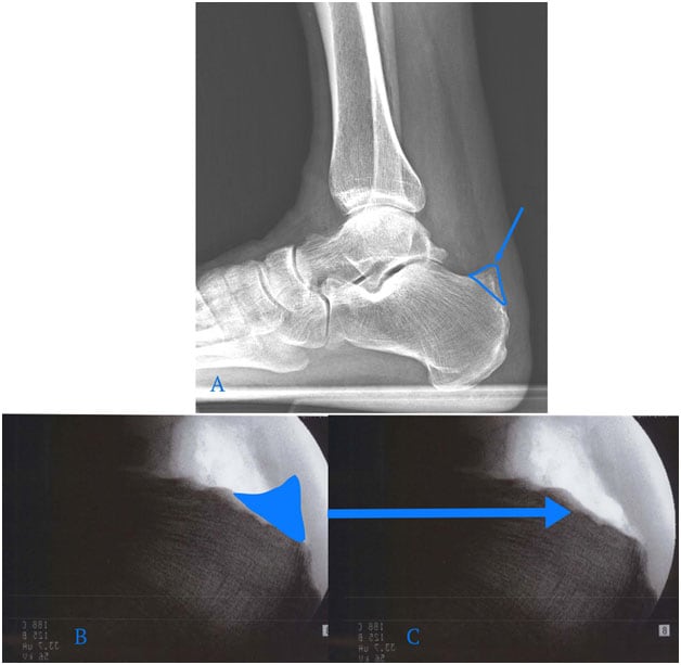 Minimally Invasive Achilles Haglund’s Syndrome and Endoscopic