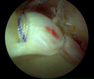 repaired acetabular labrum