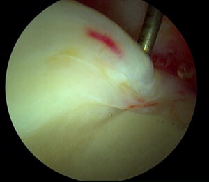 torn acetabular labrum