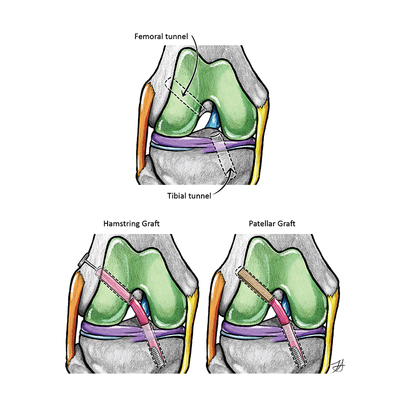 diagram of a knee, showing the femoral tunnel and tibial tunnel, a hamstring graft and a patellar graft