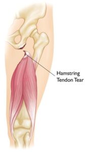 Severe hamstring injury